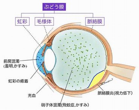 ぶどう膜炎図解